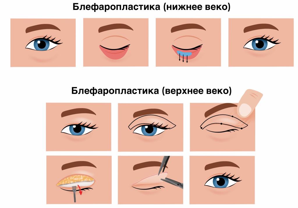 Вагинопластика - пластика влагалища (уменьшение влагалища) в Нижнем Новгороде | ТОНУС ПРЕМИУМ