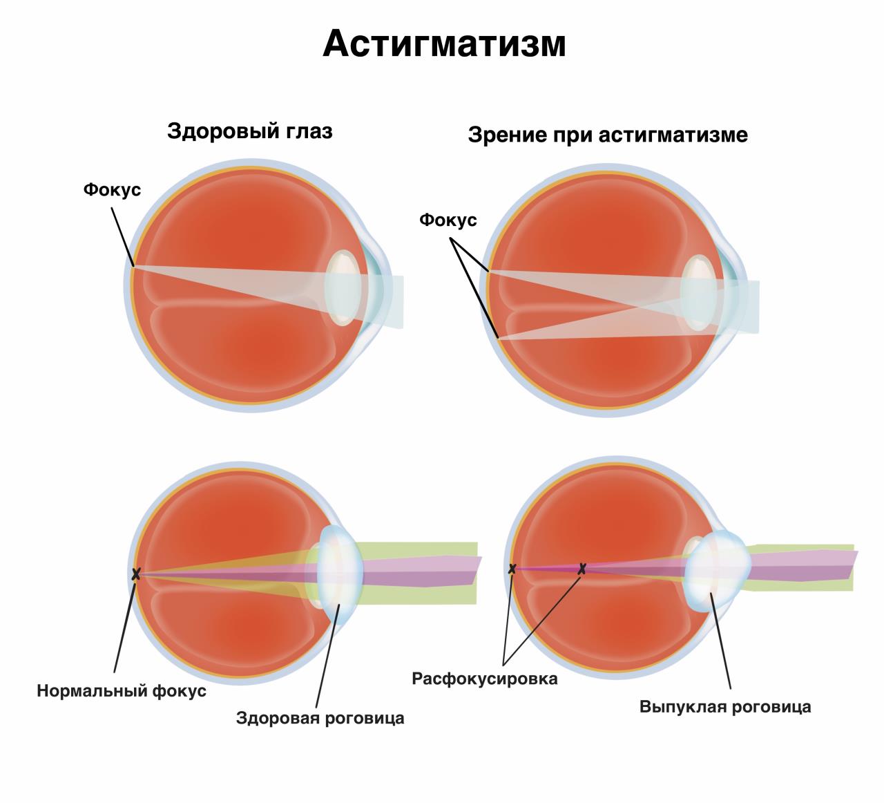 Астигматизм глаз. Гиперметропия астигматизм. Сложный гиперметропический астигматизм обоих глаз. Сложный гиперметропический астигматизм глаз
