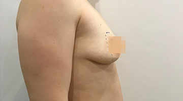 До операции мастопексия с протезированием круглыми имплантами