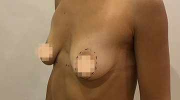 До подтяжки груди с установкой импланта