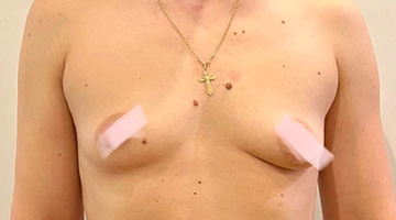 До операции мастопексия с протезированием с коррекцией асимметрии и тубулярности