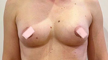После операции мастопексия с протезированием с коррекцией асимметрии и тубулярности