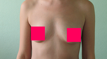 Хирургическая коррекция формы груди